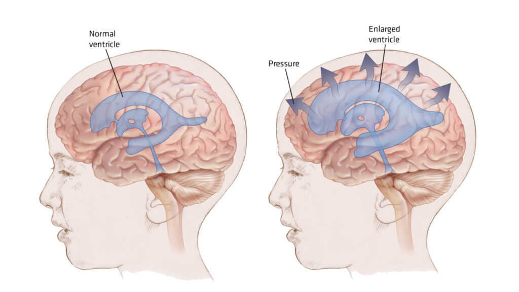 Υδροκέφαλος: Τι είναι και πώς απειλεί τη ζωή