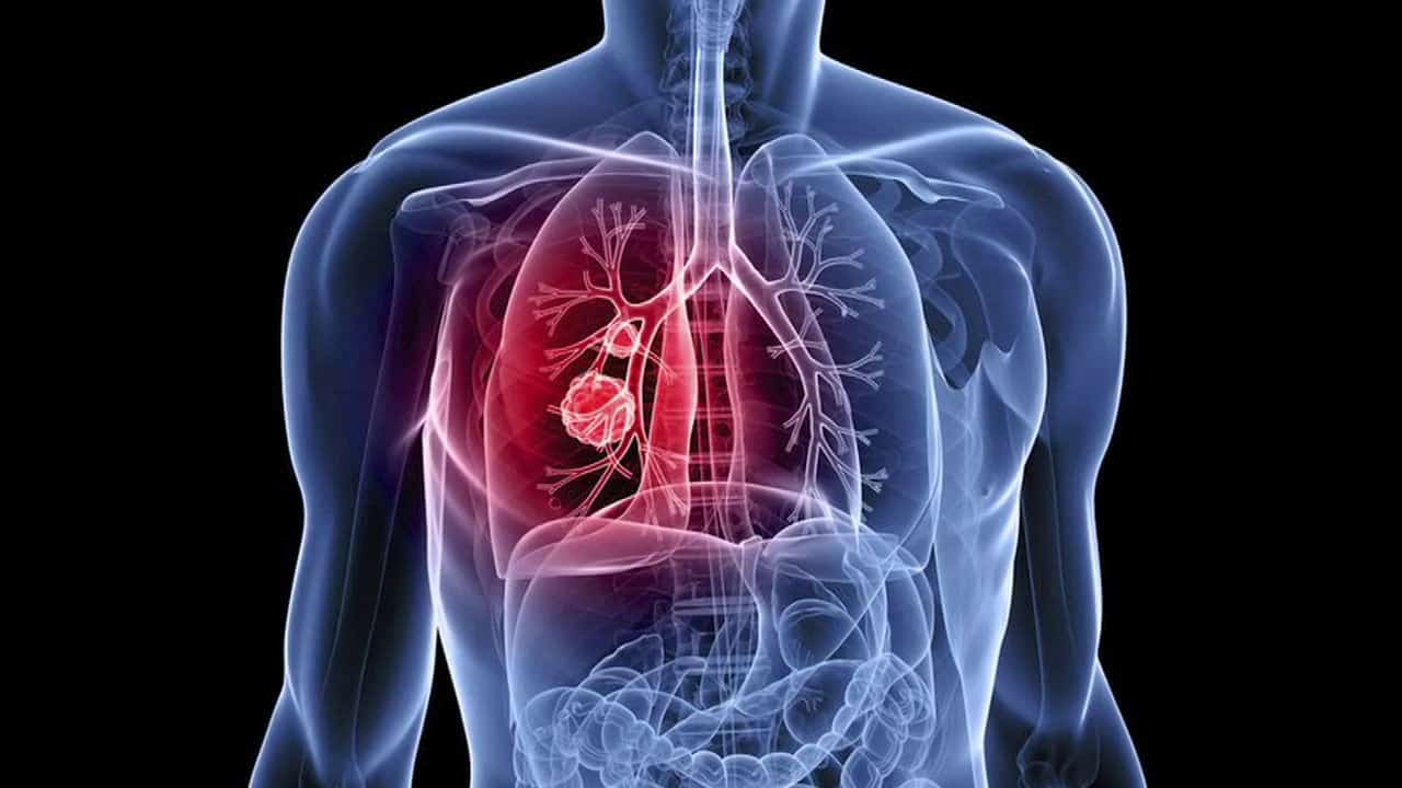 Ο καρκίνος του πνεύμονα μπορεί να διαφέρει μεταξύ Αφρο-Αμερικανών και Καυκασίων