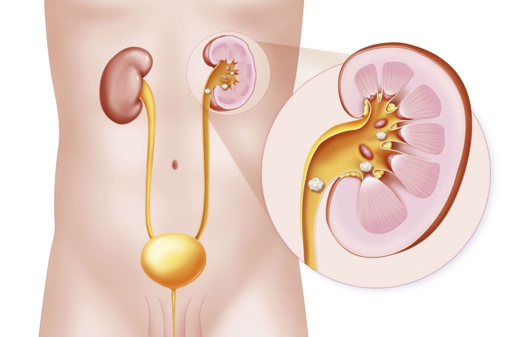 Γιατί αυξάνονται τα περιστατικά νεφρολιθίασης;