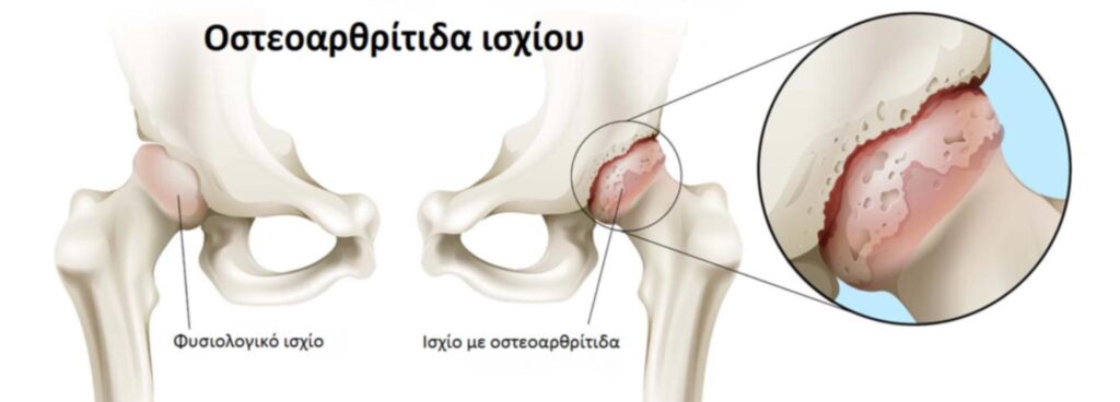 Ανακαλύφθηκαν νέα γονίδια πίσω από την οστεοαρθρίτιδα