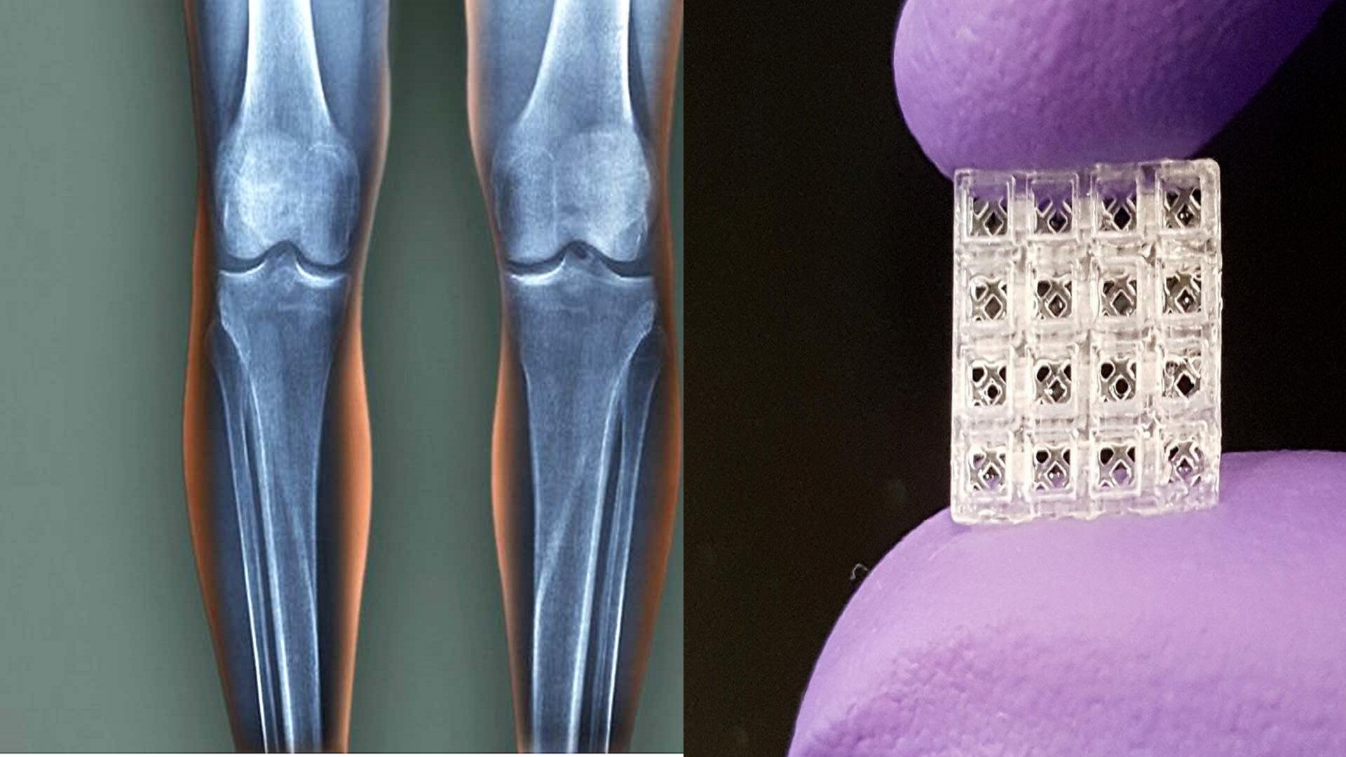 Τρισδιάστατη τεχνολογία που θυμίζει lego επισκευάζει φθαρμένα οστά