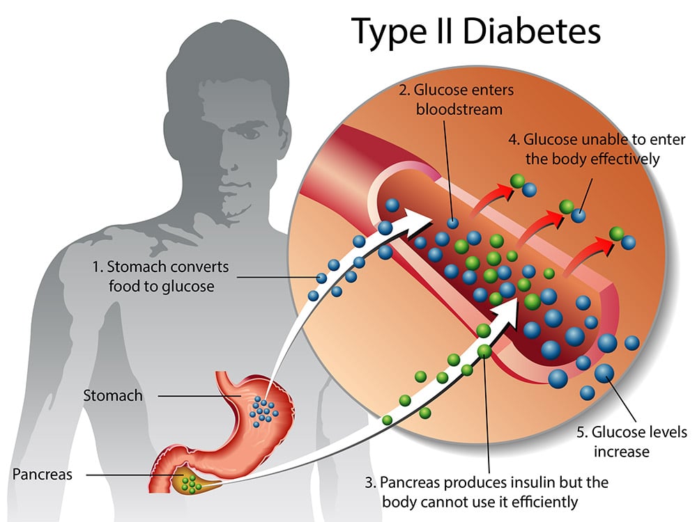 type-2-diabetes-49a3ee.jpg