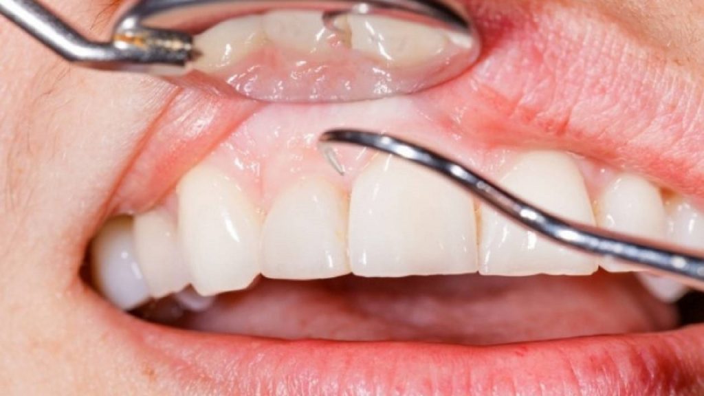 Καρκίνος διάγνωση στόμα: Η ουλίτιδα αυξάνει τον κίνδυνο