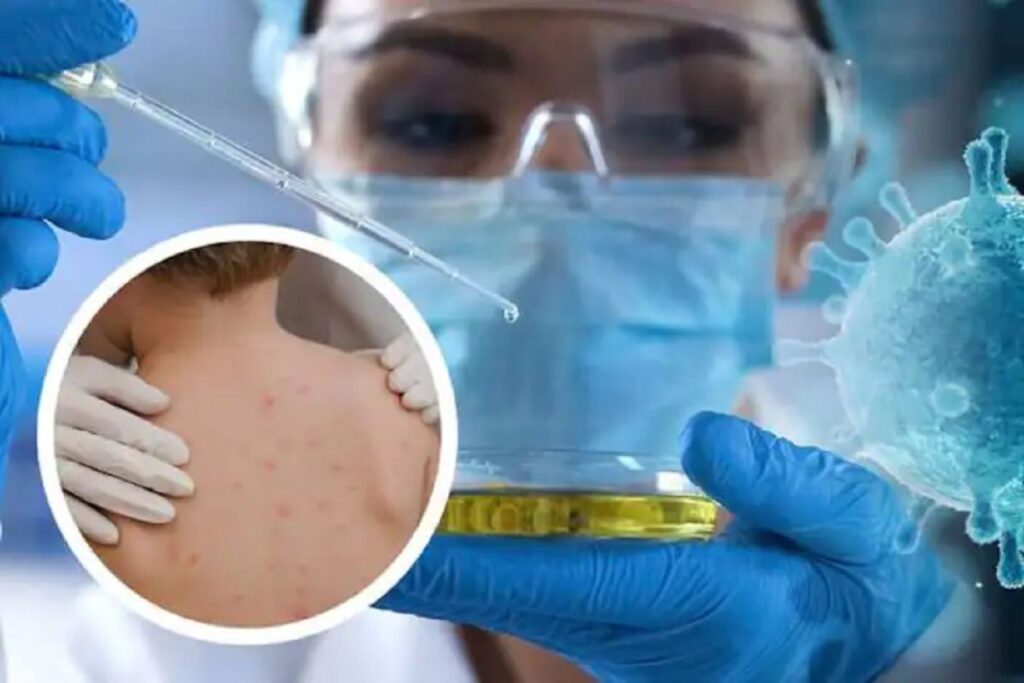 Το Πακιστάν επιβεβαιώνει το πρώτο κρούσμα mpox στη χώρα