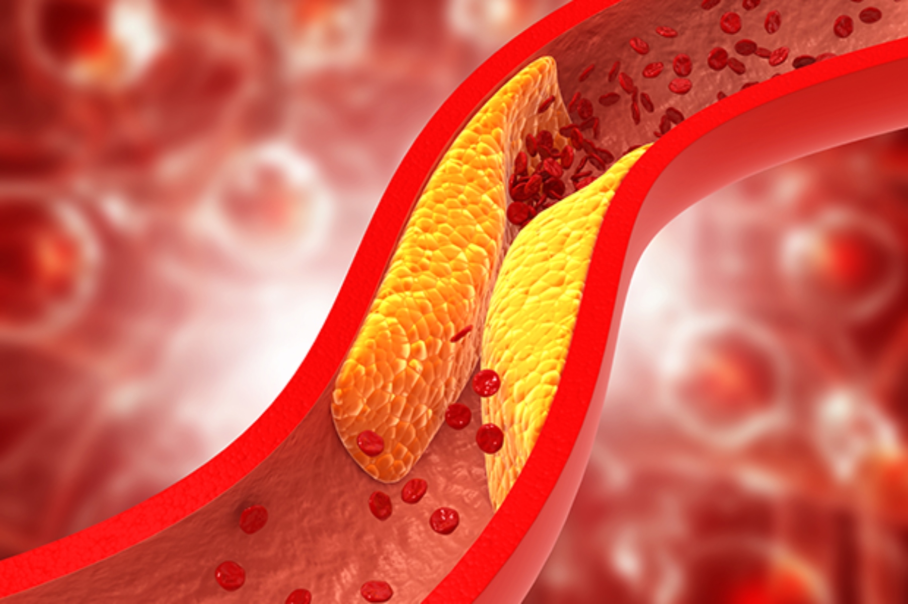 Χοληστερίνη παρενέργειες: Αποτελεσματικές θεραπείες για να διώξετε την κακή χοληστερόλη με φυσικό τρόπο