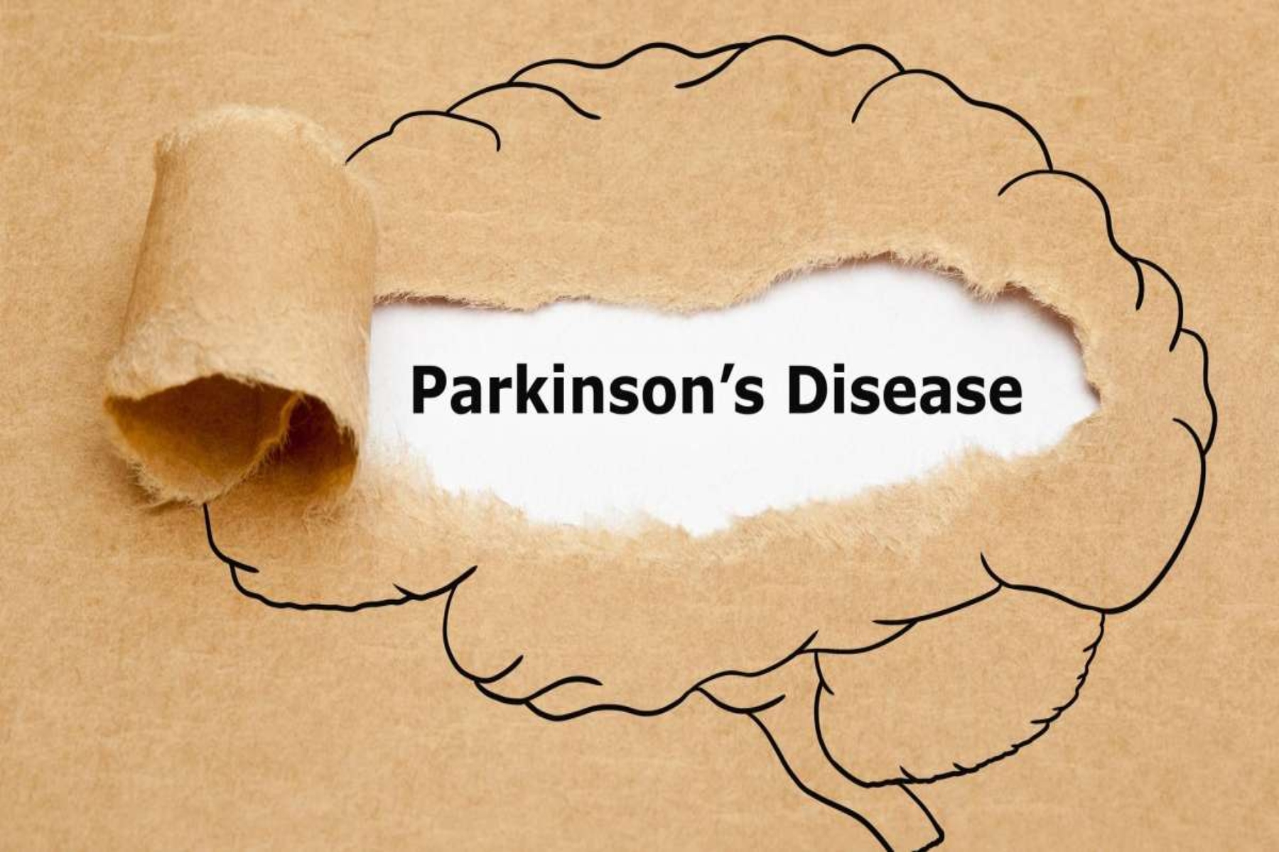 Νόσος Πάρκινσον: Γιατροί εξηγούν τις νέες καινοτομίες που αφορούν τη θεραπεία και τη διαχείριση του Πάρκινσον