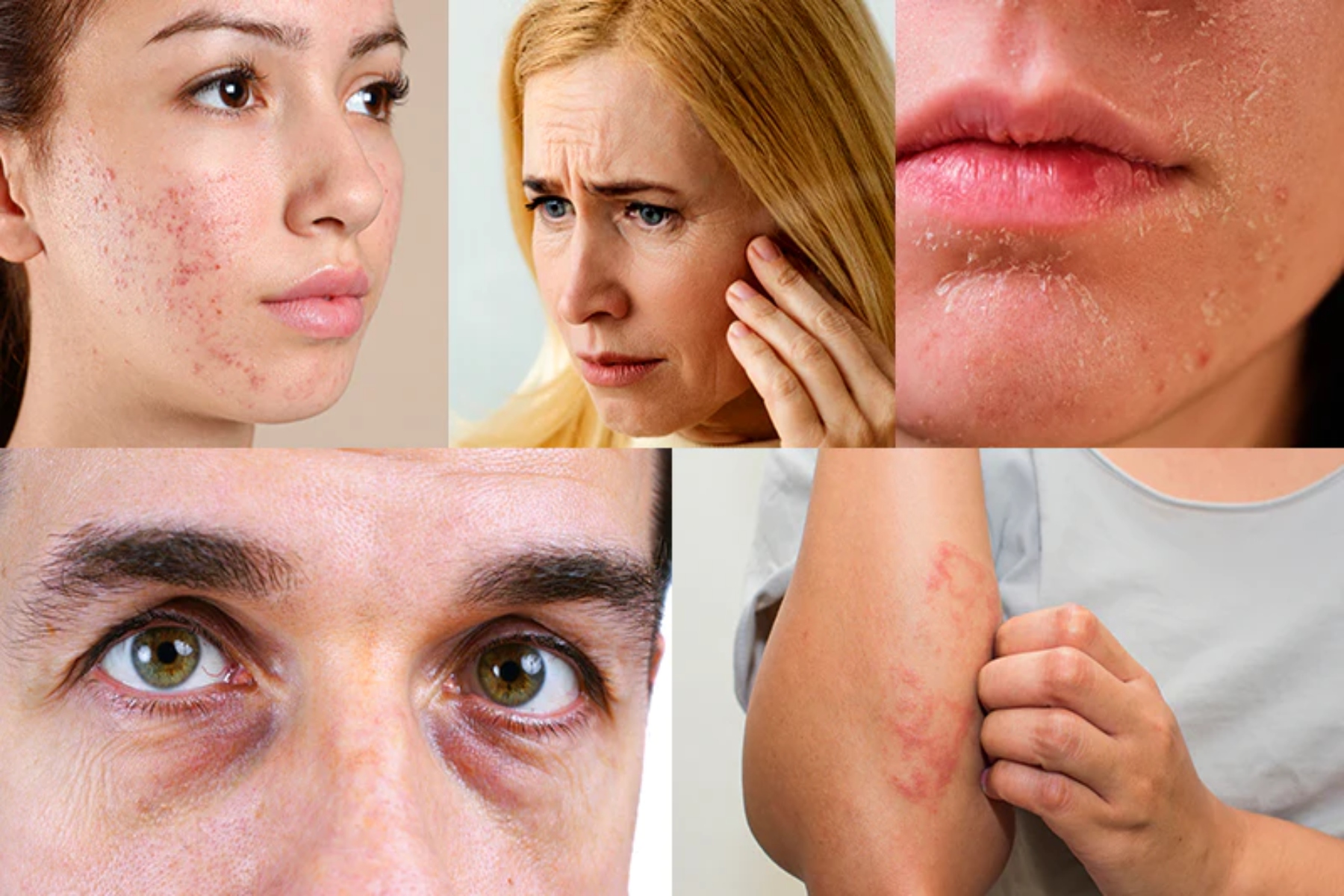Άγχος δέρμα: Το άγχος επηρεάζει το δέρμα μας και μας δείχνει προειδοποιητικά σημάδια