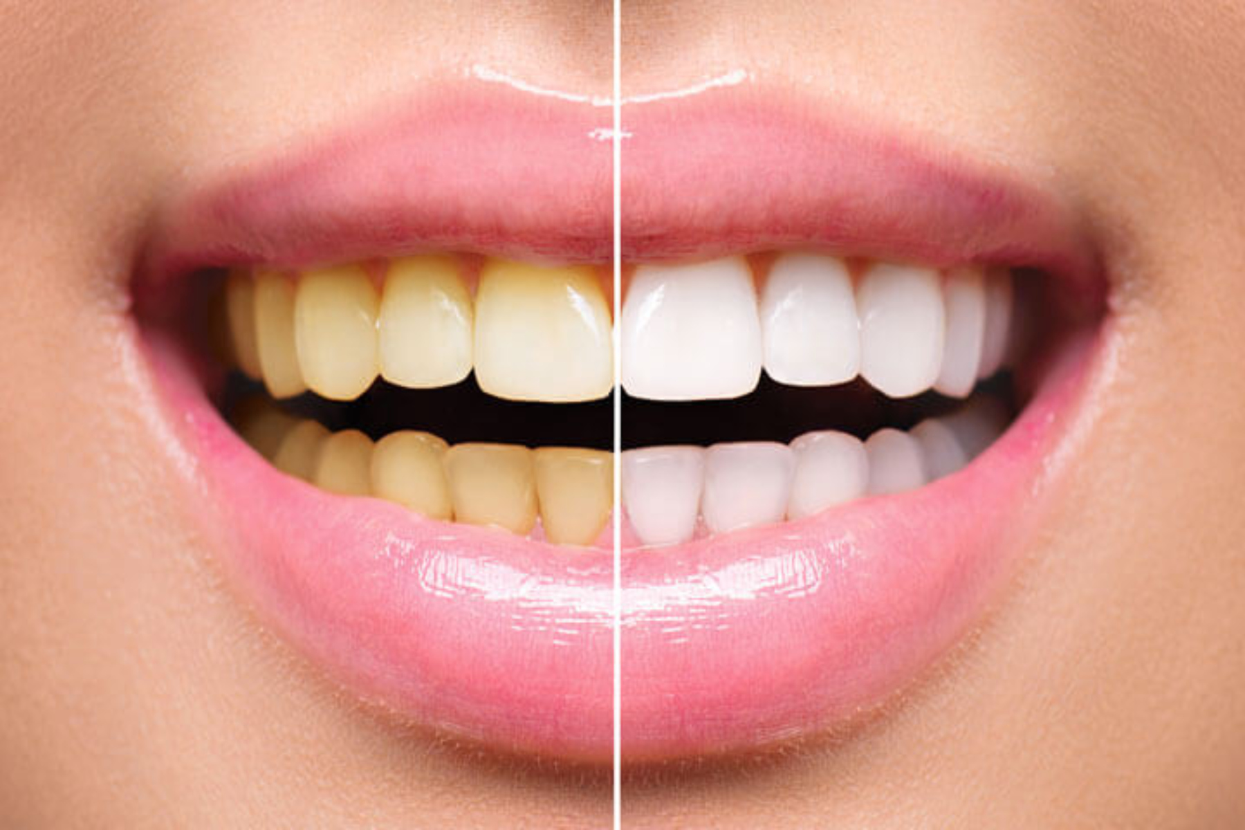 Λεύκανση δοντιών: Tips για να επιτύχει η λεύκανση δοντιών σας