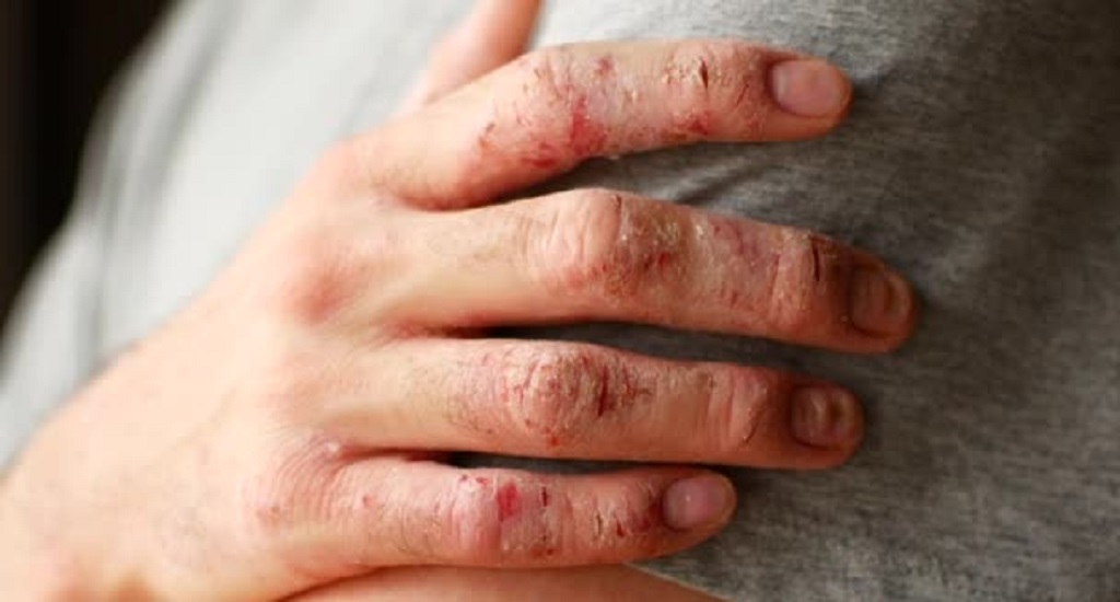 Ατοπική Δερματίτιδα: Η σύνδεση εντέρου-δέρματος είναι βασικός παράγοντας στη νόσο, σύμφωνα με έρευνα