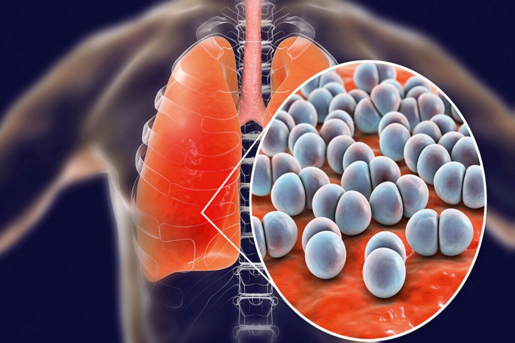 Τι ακριβώς είναι η πνευμονία και πώς πρέπει να την αντιμετωπίσουμε;