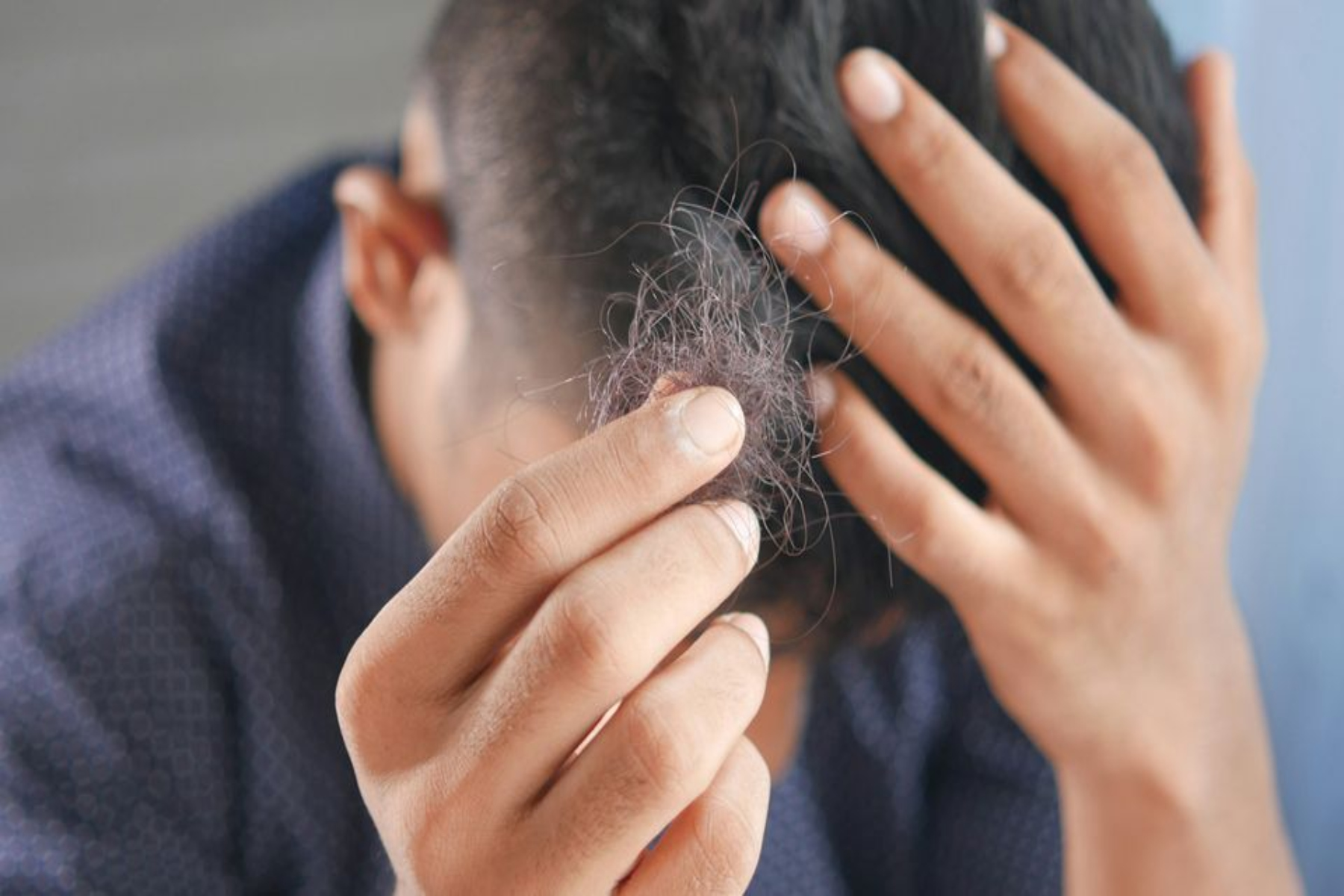 Αλλωπεκία ερευνα: Νέο έμπλαστρο υπόσχεται την αναγέννηση των μαλλιών που χάθηκαν στην γυροειδή αλωπεκία