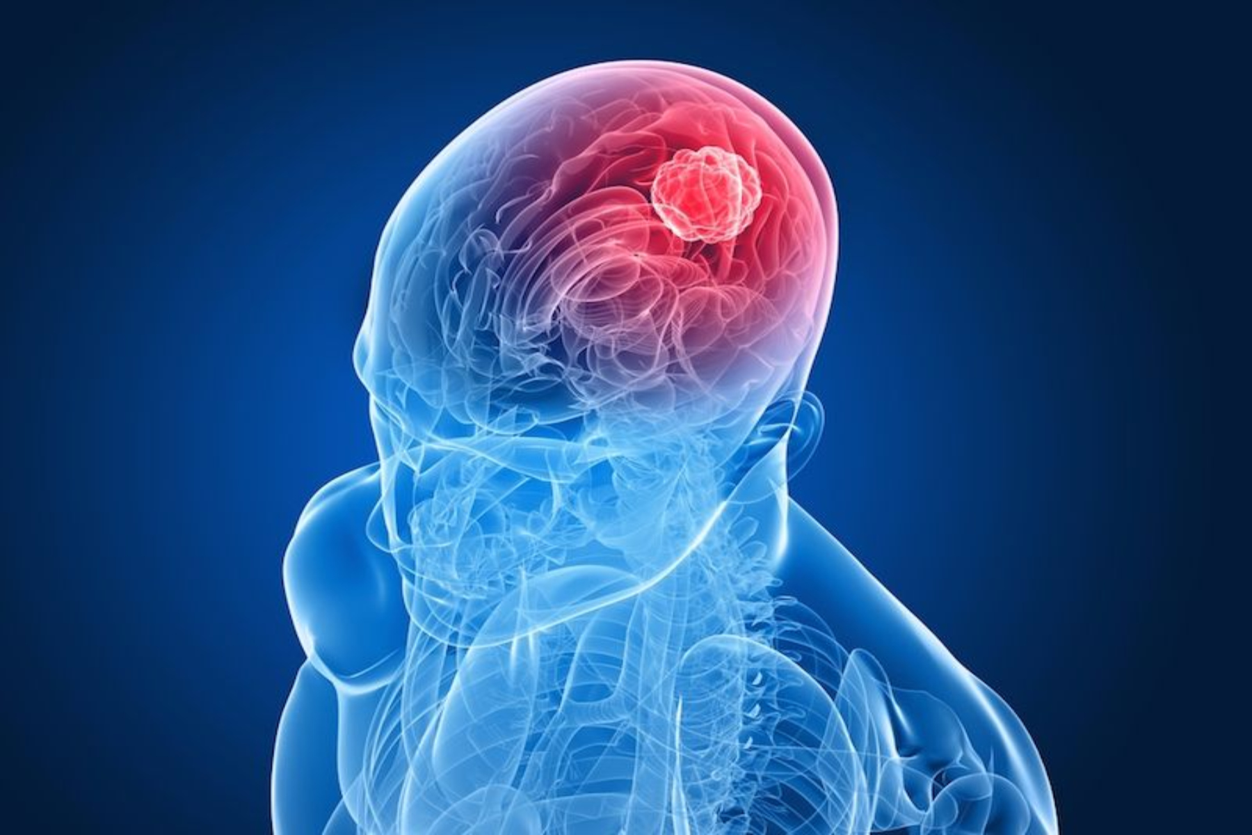 Καρκίνος εγκέφαλος: Τι πρέπει να λαμβάνουν υπόψη οι ασθενείς με καρκίνο εγκεφάλου;