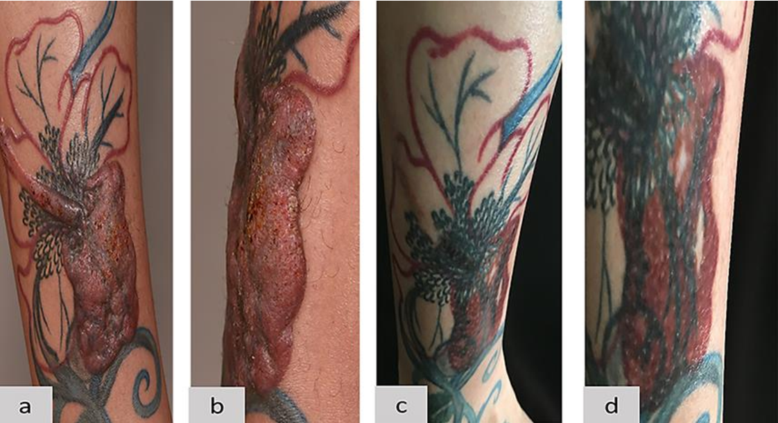 Tattoo: Αποκαλύφθηκε πιθανή συσχέτιση μεταξύ τατουάζ και λεμφώματος