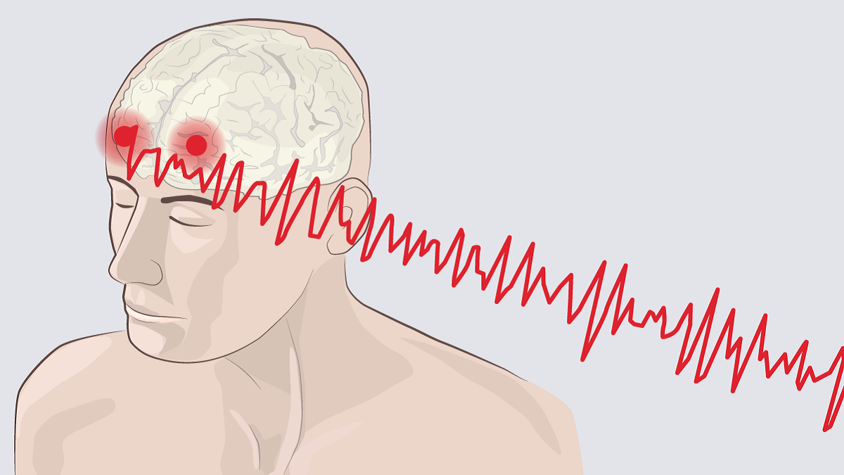 Άνοια: Νέα τεχνική χρησιμοποιεί τον ήχο για να επηρεάσει τα εγκεφαλικά κύματα και τον ύπνο στη νόσο
