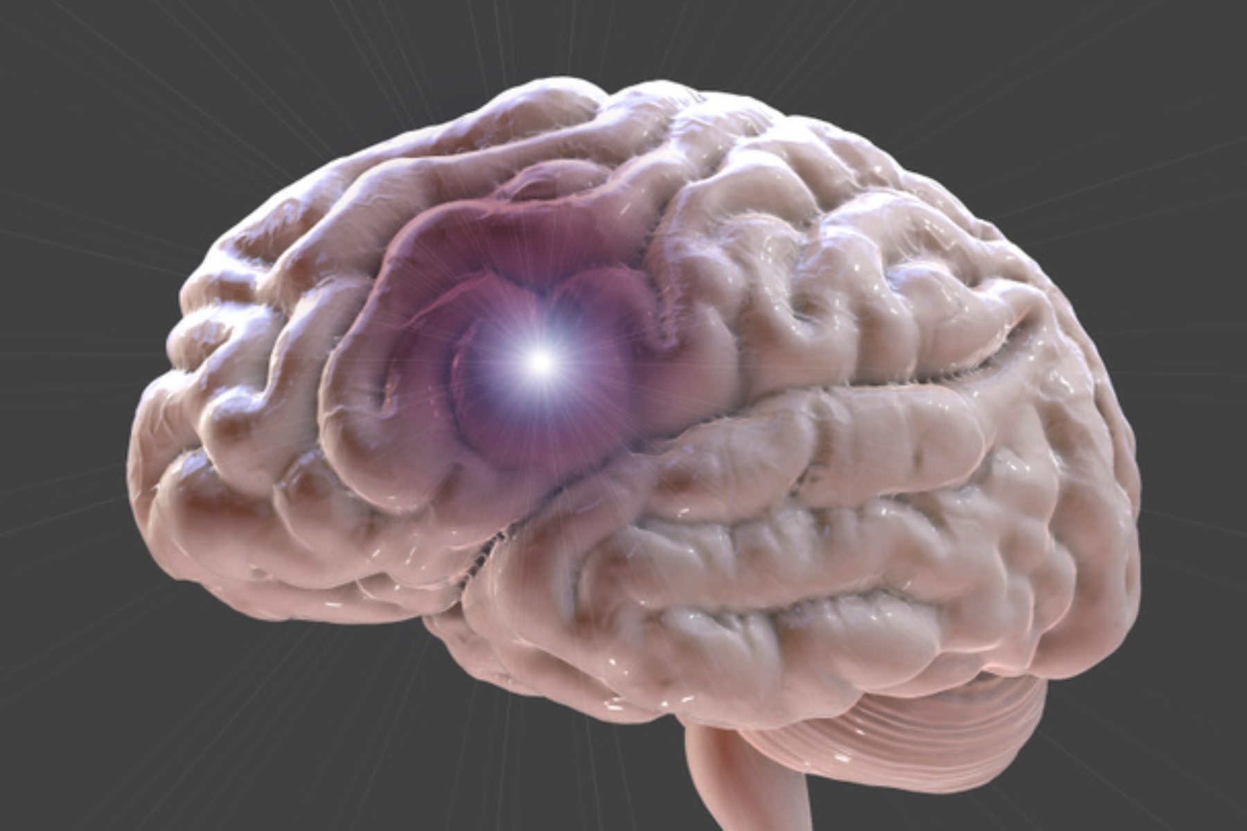 Εγκεφαλικό ανεύρυσμα: Τι είναι και ποια τα προειδοποιητικά σημάδια;