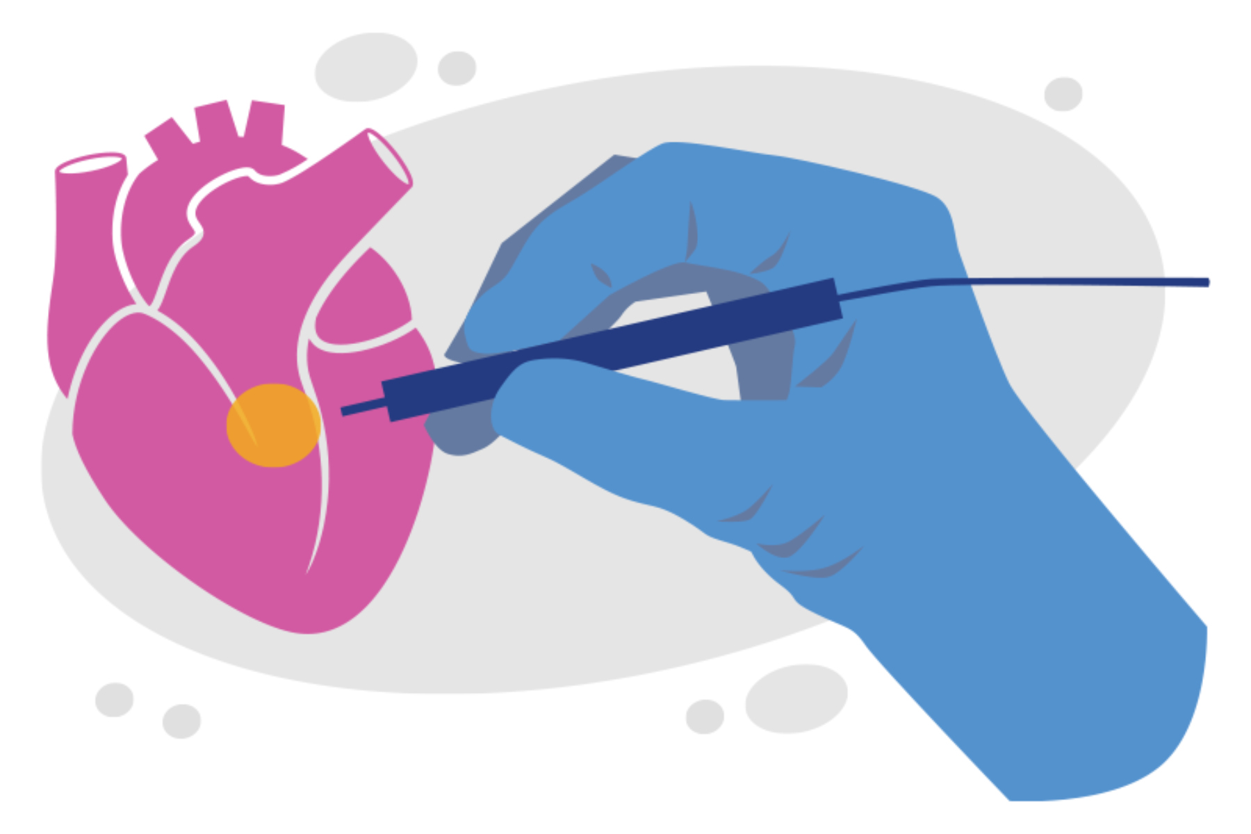 Καρδιακή αρρυθμία: Τι είναι η καρδιακή αρρυθμία και πώς να την προλάβετε