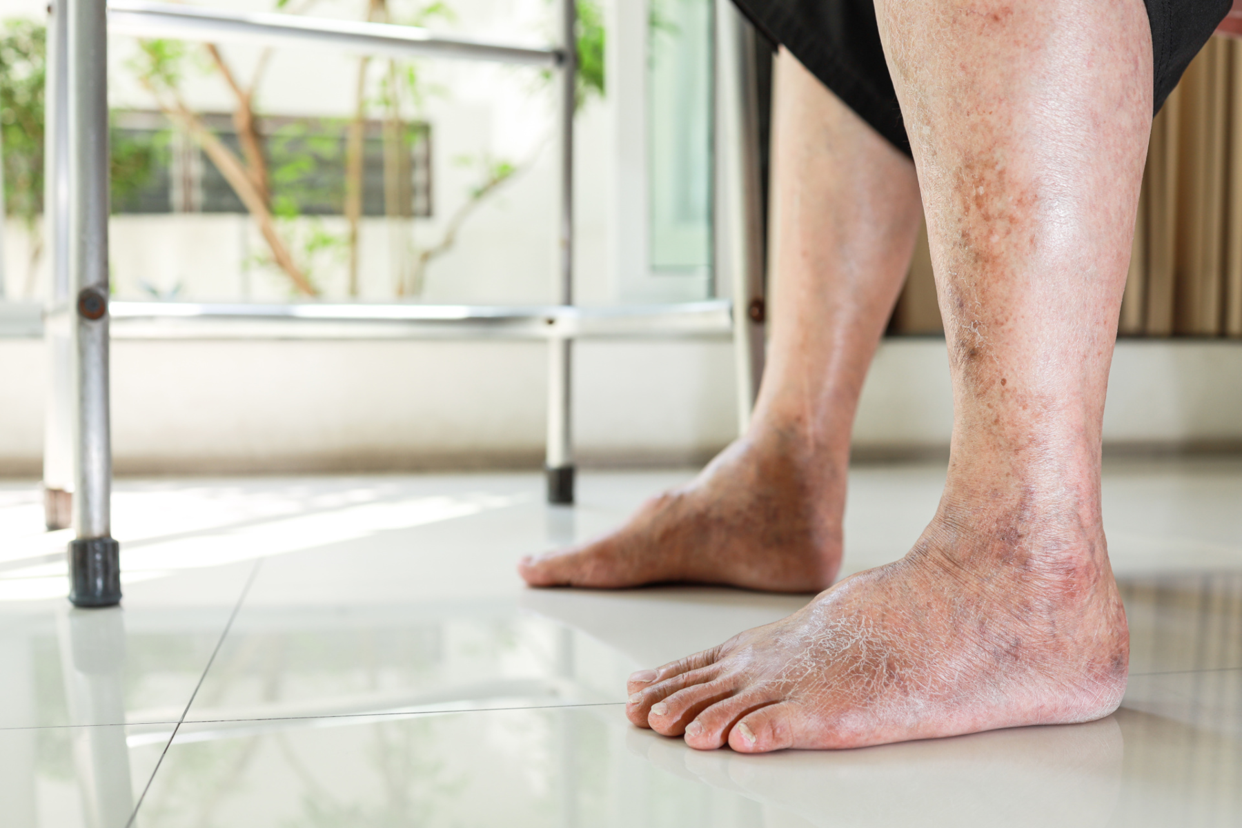 Φραγμένες αρτηρίες: Προειδοποιητικά σημάδια φραγμένων αρτηριών στα πόδια και τα πόδια τη νύχτα