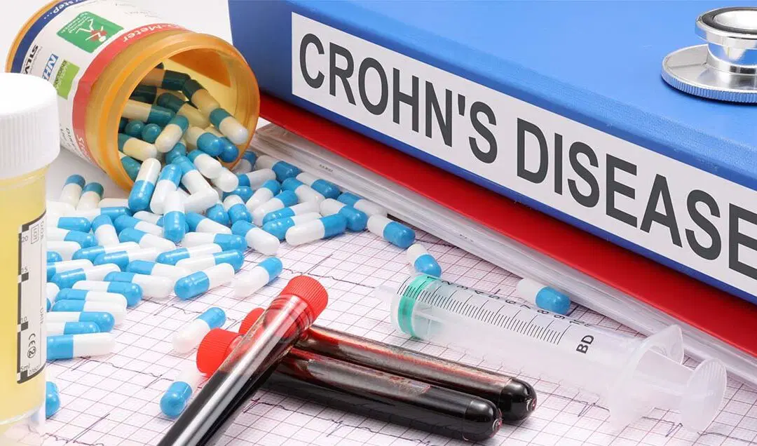 Νόσος του Crohn: Ερευνητές του Πανεπιστημίου του Κέιμπριτζ στην εύρεση εξατομικευμένων θεραπειών