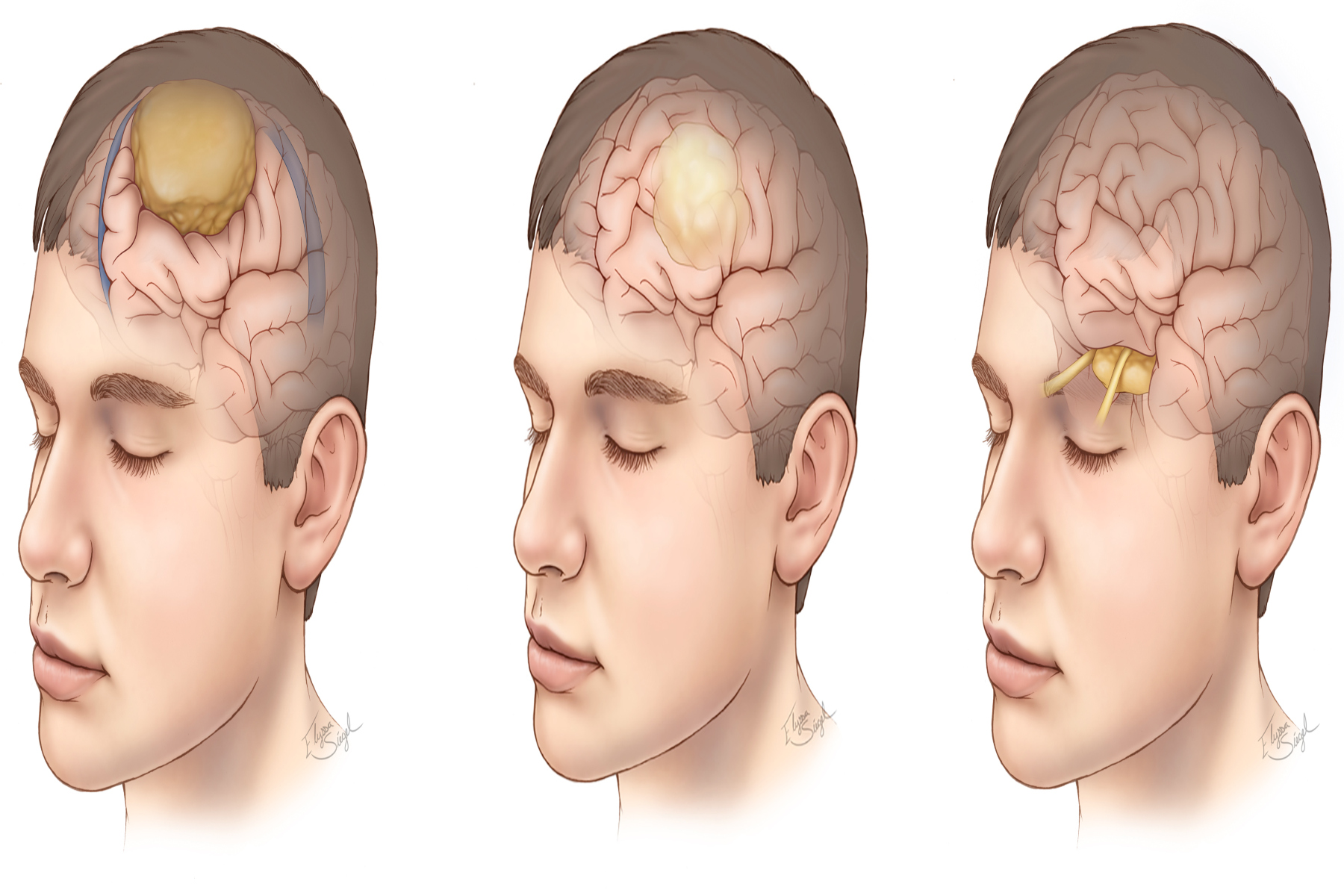 Όγκος εγκεφάλου: Είναι ο όγκος εγκεφάλου θανατηφόρος; Ποιες είναι οι επικίνδυνες πτυχές του;