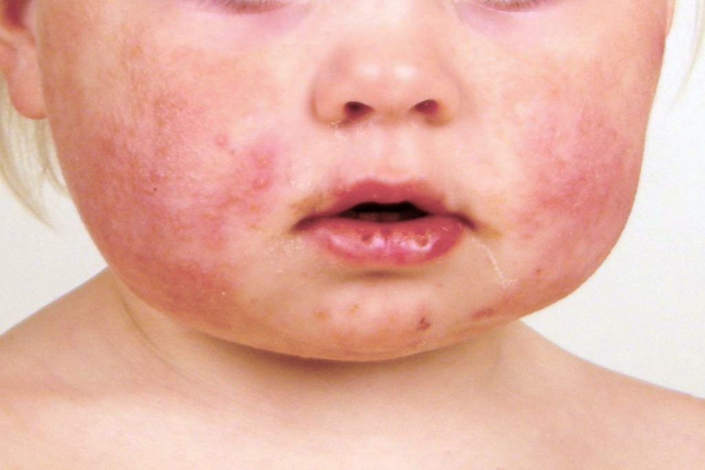Μια κοινή μόλυνση που συνήθως επηρεάζει τα παιδιά ηλικίας 2 ετών