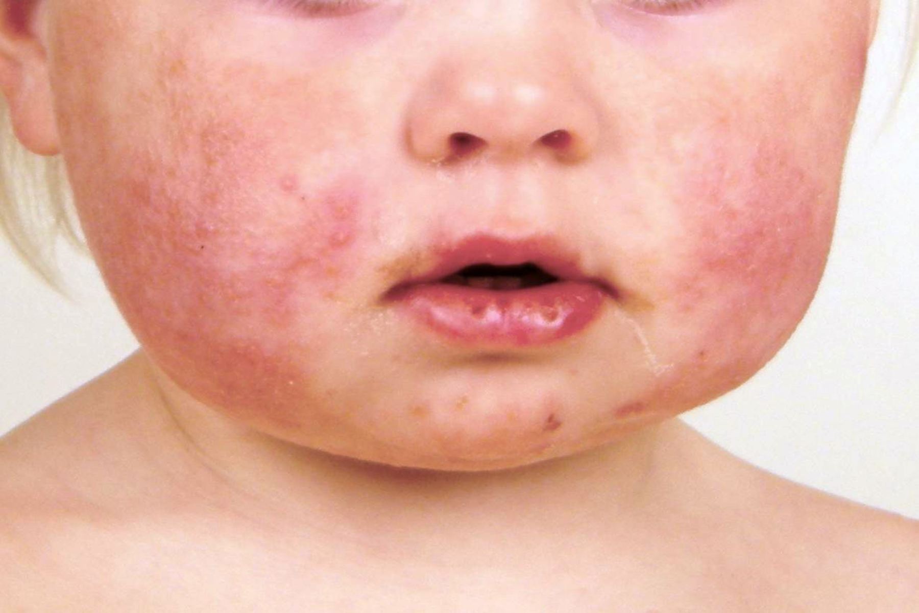 Αιφνίδιο εξάνθημα: Μια κοινή μόλυνση που συνήθως επηρεάζει τα παιδιά ηλικίας 2 ετών