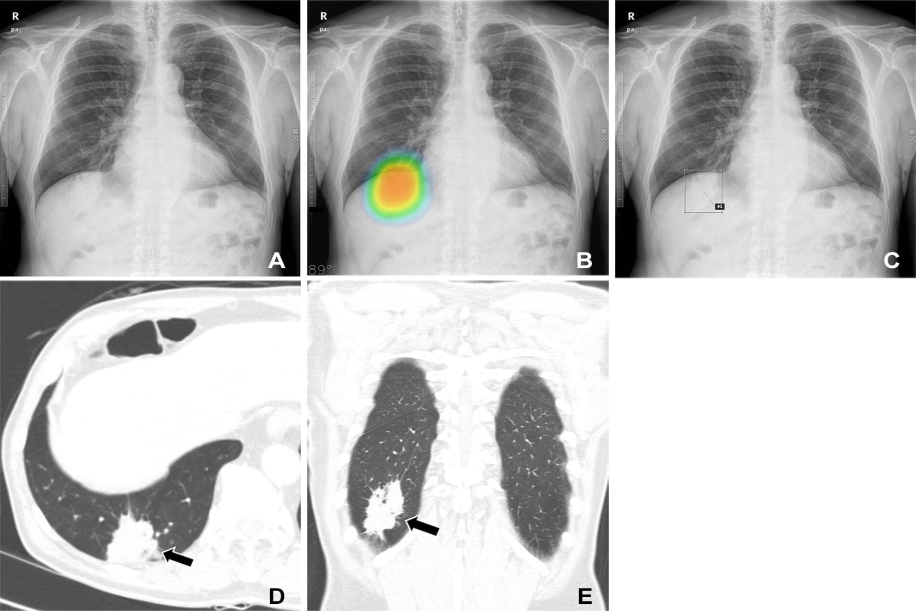 ΑΙ καρκίνος: Πρόγραμμα AI διαγιγνώσκει με ακρίβεια τον καρκίνο του πνεύμονα από εικόνες ιστού