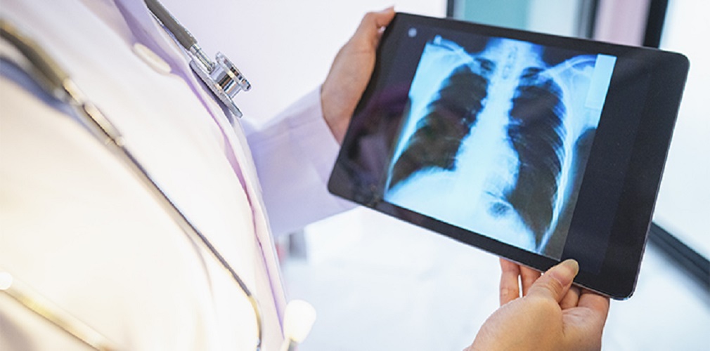 Καρκίνος του Πνεύμονα: Ο προσυμπτωματικός έλεγχος βρέθηκε ότι παρατείνει τη ζωή