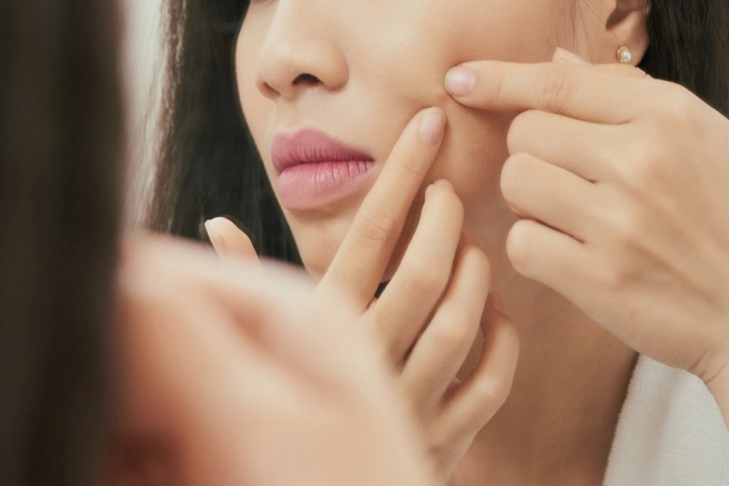 Μαύρα στίγματα: Κορυφαίες συμβουλές ομορφιάς για καθαρότερο δέρμα