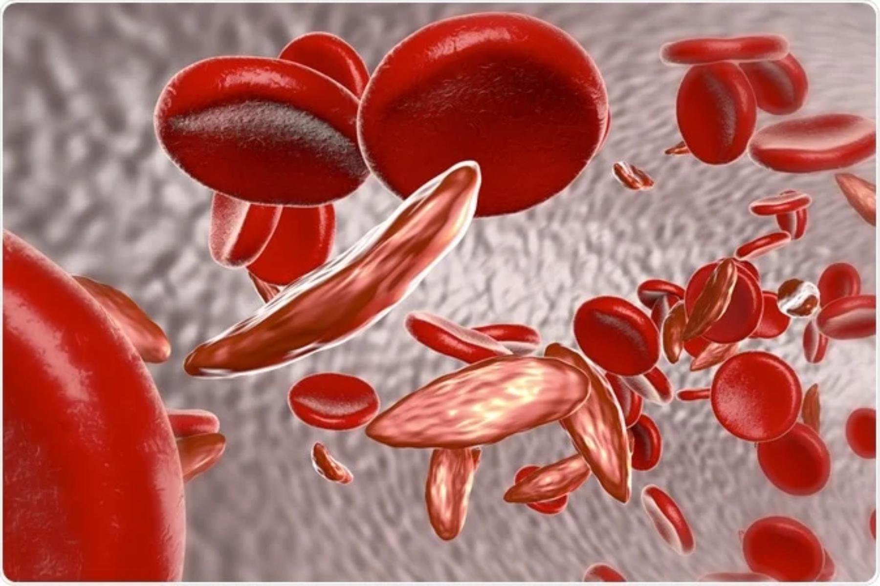 Δρεπανοκυτταρική αναιμία: Πώς η δρεπανοκυτταρική αναιμία επηρεάζει την έμμηνο ρύση;