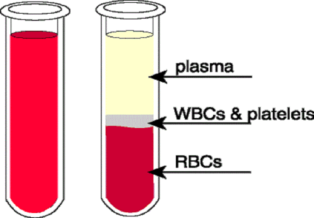 Σήψη: Το πρότυπο των επιπέδων πρωτεΐνης στο πλάσμα του αίματος αποκαλύπτει την ανάπτυξη της νόσου