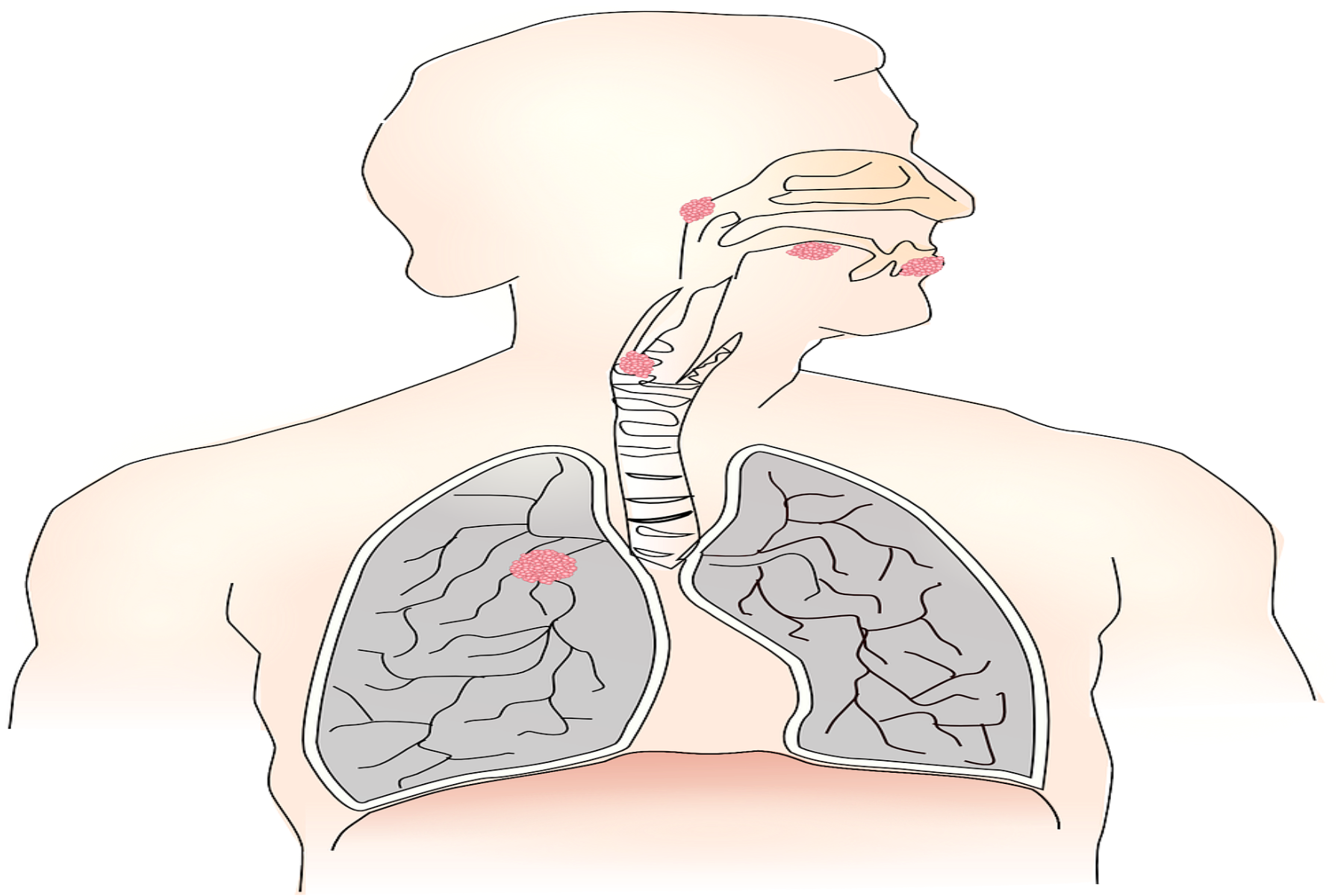 Kαρκίνος του πνεύμονα: Ζωτικής σημασίας ο προσυμπτωματικός έλεγχος