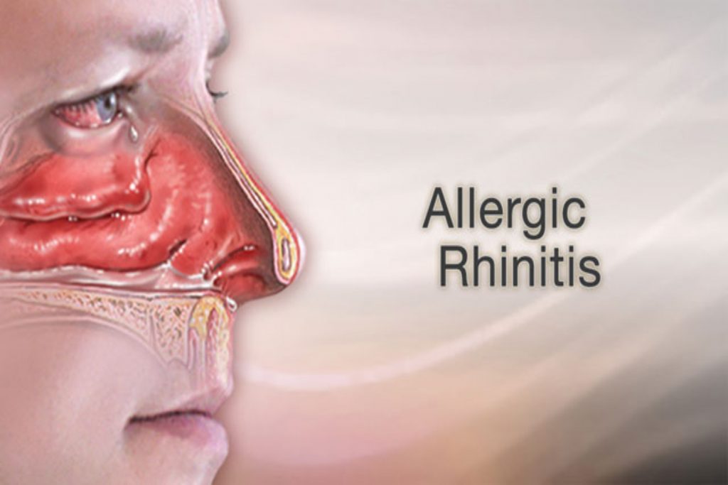 Τι είναι η αλλεργική ρινίτιδα και πώς αντιμετωπίζεται;