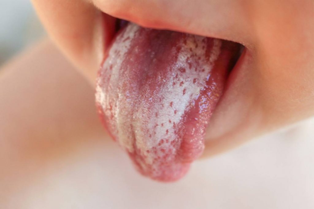 Όλα όσα πρέπει να γνωρίζετε για τη στοματική έκκριση μια μυκητιασική λοίμωξη του στόματος
