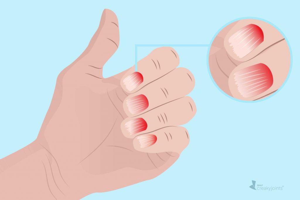 Σημάδια ψωριασικής αρθρίτιδας στα χέρια, τα δάχτυλα και τα νύχια σας