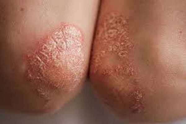 psoriasis