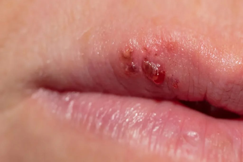 Μπορούν οι πληγές του στόματος να υποδεικνύουν προβλήματα στο στομάχι;